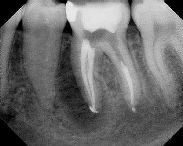 Root canal with large lesion - Stratford