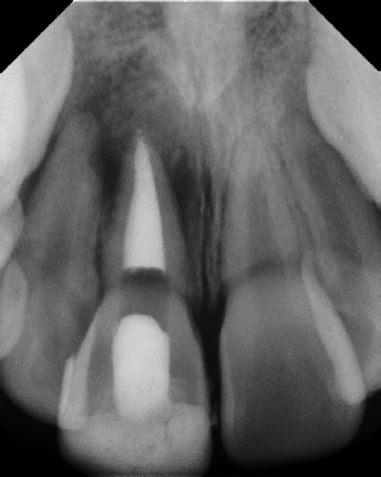 Root canal with large lesion - Meriden