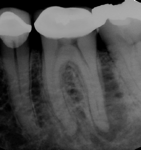Root canal with large lesion - Meriden