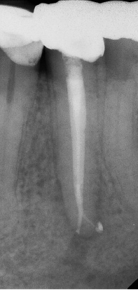 Root canal with large lesion - Stratford