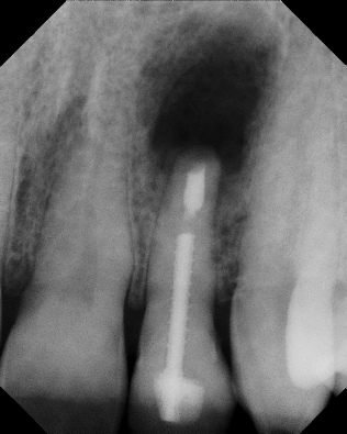 Apicoectomy - Surgical Root Canal