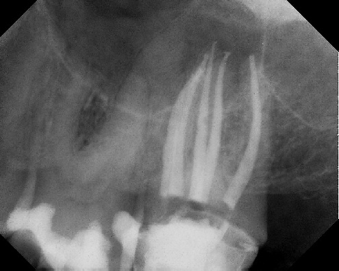 Root Canal Anatomy - Meriden
