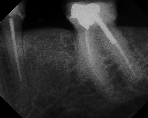 Root Canal - Broken Instrument Removal