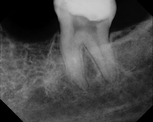 Root Canal - Broken Instrument Removal