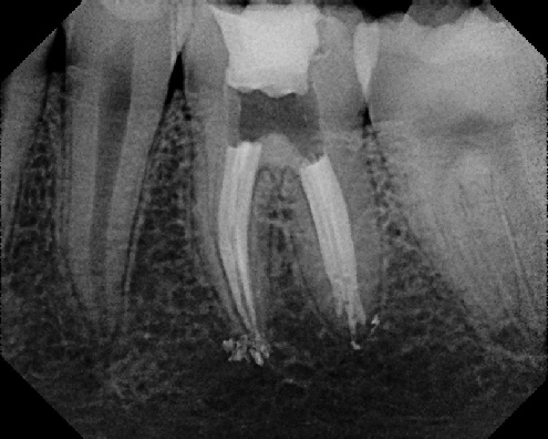 root canal anatomy - Meriden