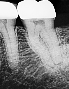 Root Canal - Access Through Crown