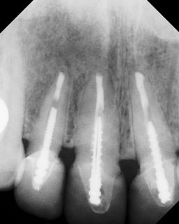 Apicoectomy - Surgical Root Canal