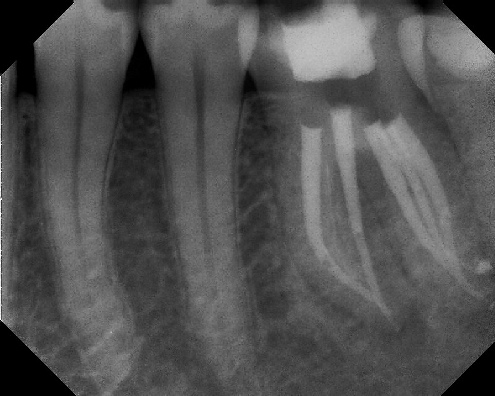 root canal anatomy - Meriden