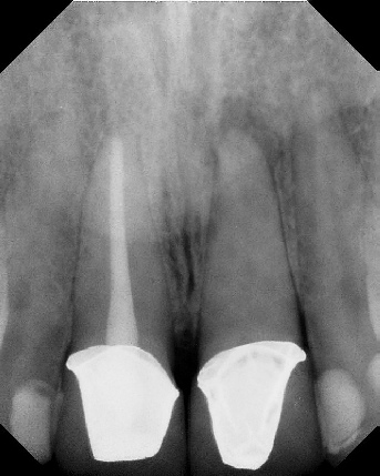 Root Canal with Calcified Canals - Meriden