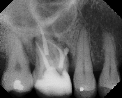 Root Canal - Broken Instrument Removal