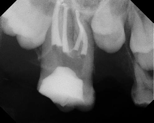 root canal anatomy - Meriden