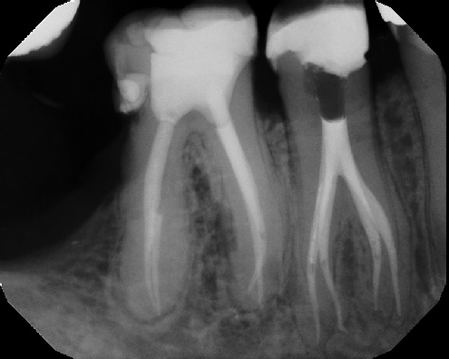Root Canal Anatomy - Meriden