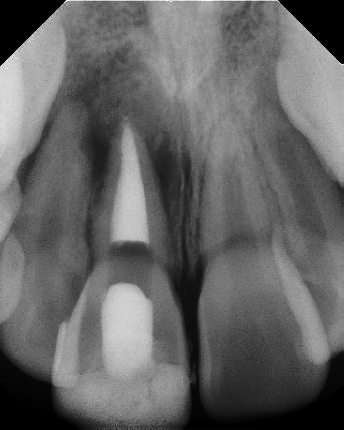 Root canal with large lesion - Meriden
