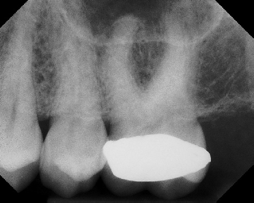 Root Canal with Calcified Canals - Meriden