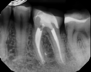 Root canal with large lesion - Stratford