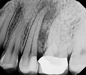 Root canal with large lesion - Stratford
