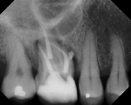 Root Canal - Broken Instrument Removal