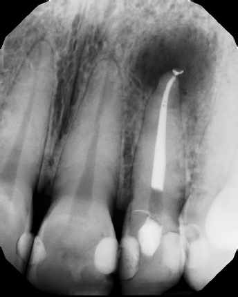 Root canal with large lesion - Meriden
