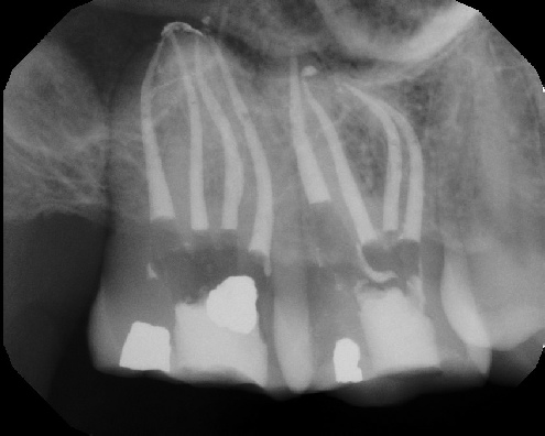 root canal anatomy - Meriden
