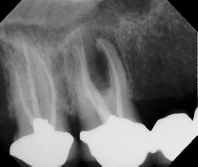 Root Canal Retreatment - Meriden