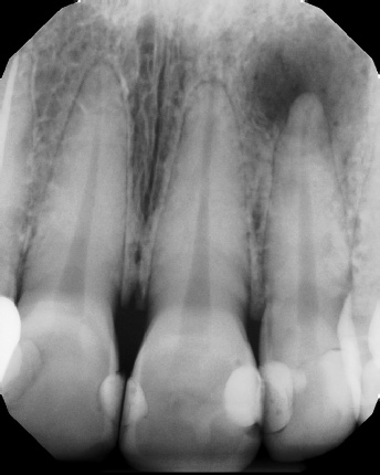 Root canal with large lesion - Meriden