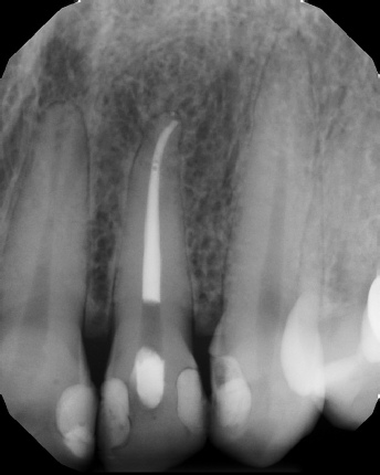 Root canal with large lesion - Meriden