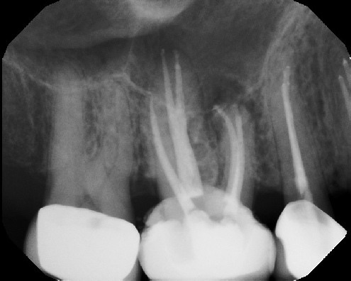 root canal anatomy - Meriden