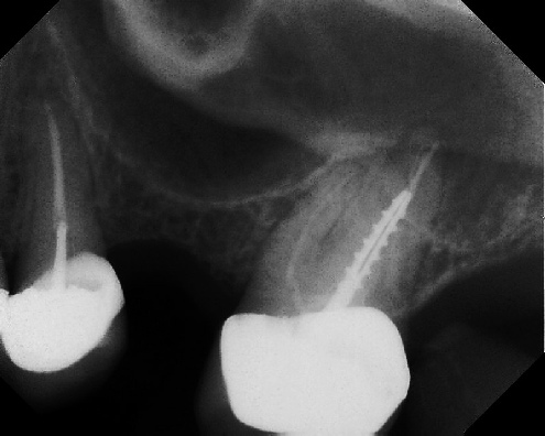 Root Canal Retreatment - Stratford