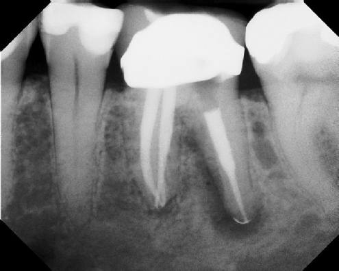 Root Canal Retreatment - Stratford