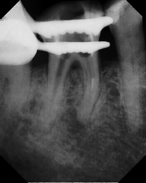 Root Canal - Broken Instrument Removal