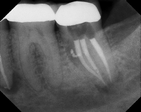 Root Canal Retreatment - Meriden