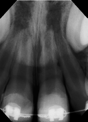 Root canal - Apexification