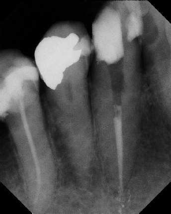 Root Canal - Broken Instrument Removal