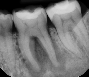 Root canal with large lesion - Stratford