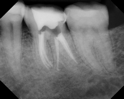 root canal anatomy - Stratford