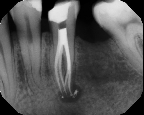 Root Canal Anatomy - Stratford