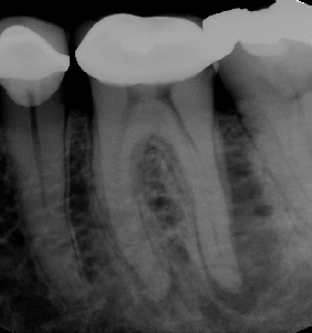 Root canal with large lesion - Meriden