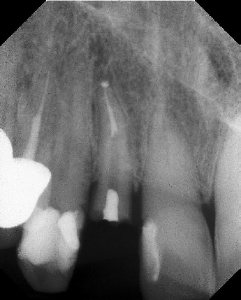 Root Canal with Calcified Canals - Stratford