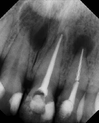 Root Canal - Broken Instrument Removal