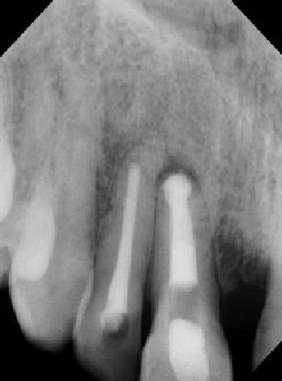 Root canal - Apexification