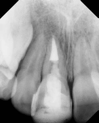 Root canal with large lesion - Meriden