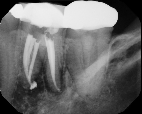 root canal anatomy - Meriden