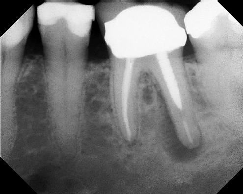 Root Canal Retreatment - Stratford