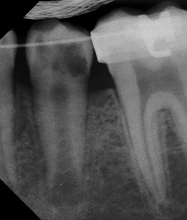 Root canal - Apexogenesis